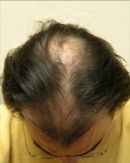 Hair Loss Before Mens