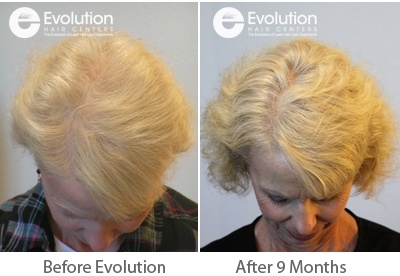 Womens Hair Loss Before and After Crown