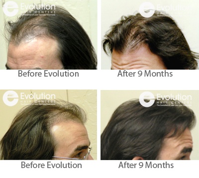 Mens Hair Loss Reversal Results after 9 months
