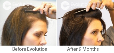 Womens Hair Loss | Female Hair Loss Treatment