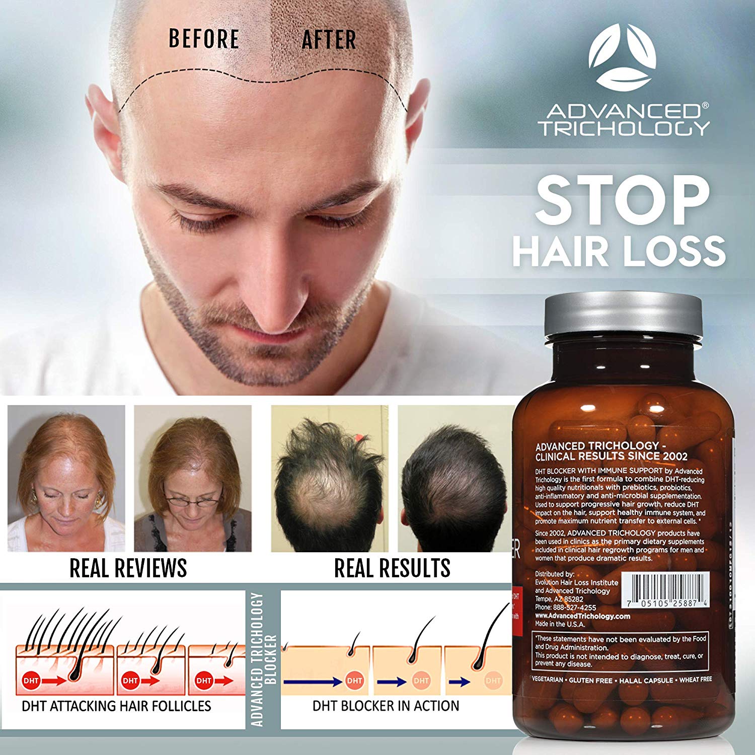 Finasteride vs. DHT Blocker Supplement for Hair Loss