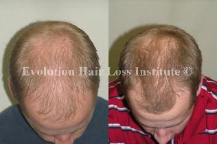Before and After Photo Hair Loss Treatment Male Blond Young