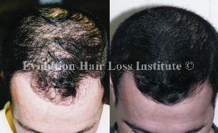 Before and After Photo Hair Loss Treatment Male Black Middle Vertex