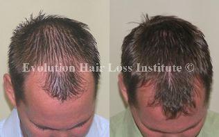 Before and After Photo Hair Loss Treatment Male Brown Middle Vertex