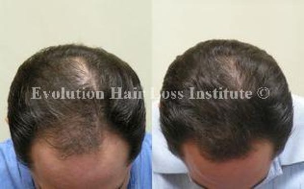 Before and After Photo Hair Loss Treatment Male Black Frontal Hair Regrowth