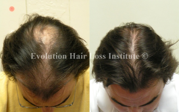 Before and After Photo Hair Regrowth Male Dark Long Hair
