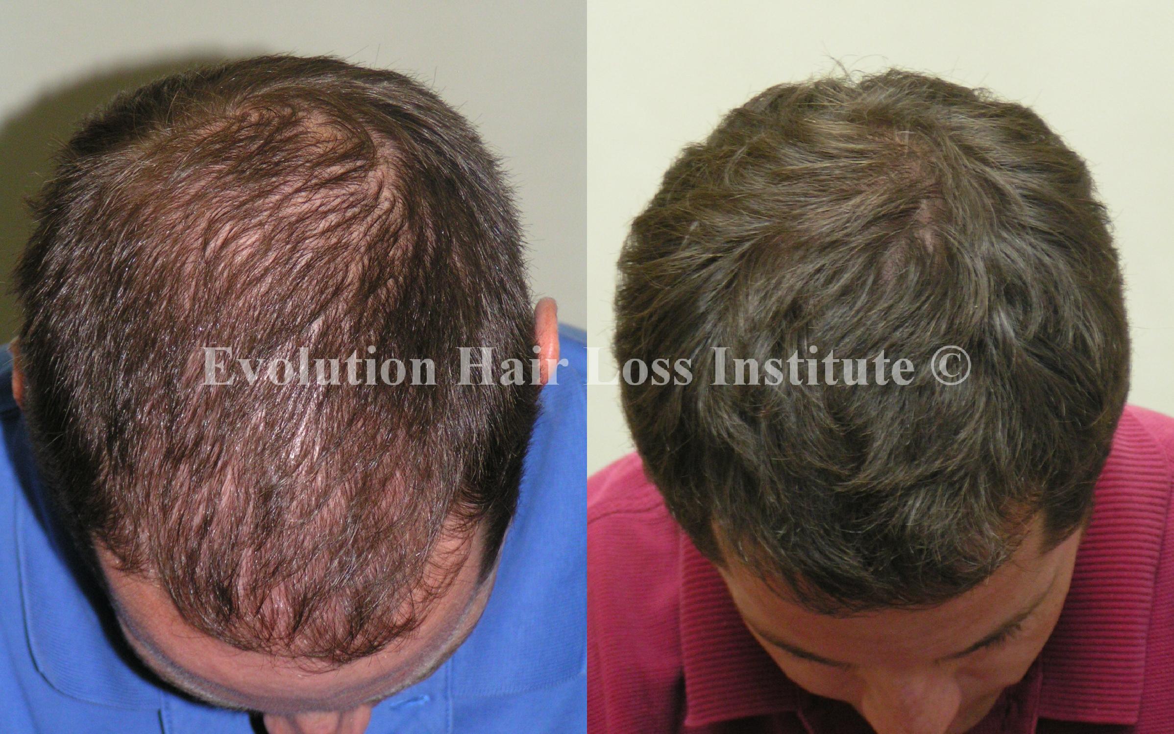 Before and After Photo Hair Regrowth Male Dark Short Hair