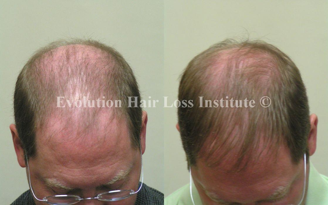 Before and After Photo Hair Regrowth Male Older Thin Hair