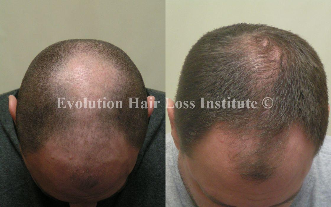 Before and After Photo Hair Loss Treatment Male Crown and Frontal