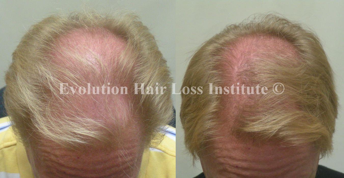 Before and After Photo Hair Loss Treatment Male Blond Crown Older