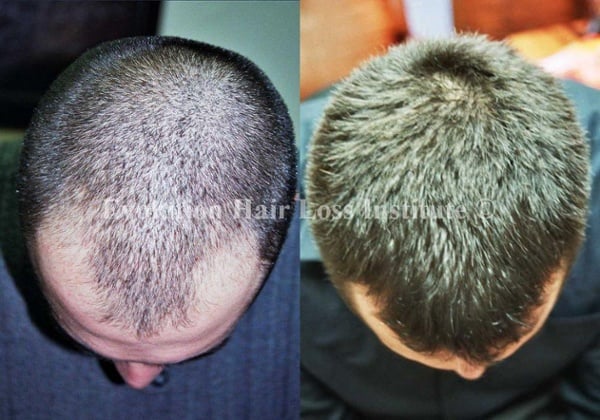 Before and After Photo Hair Regrowth Male Dark Frontal Hair Loss