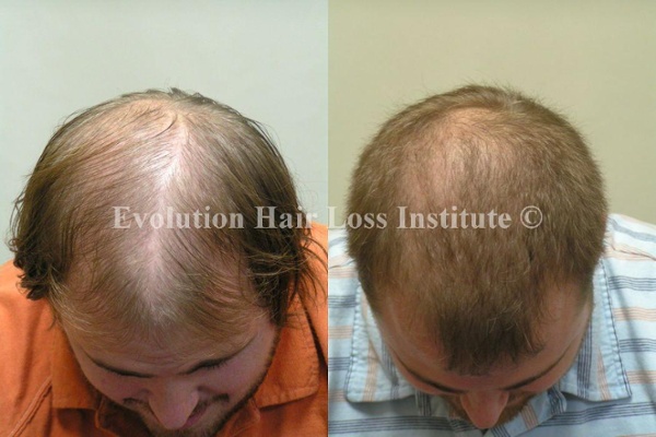 Before and After Photo Hair Regrowth Male Short Light Hair