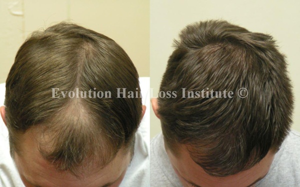 Before and After Photo Hair Loss Treatment Male Brown Long Hair