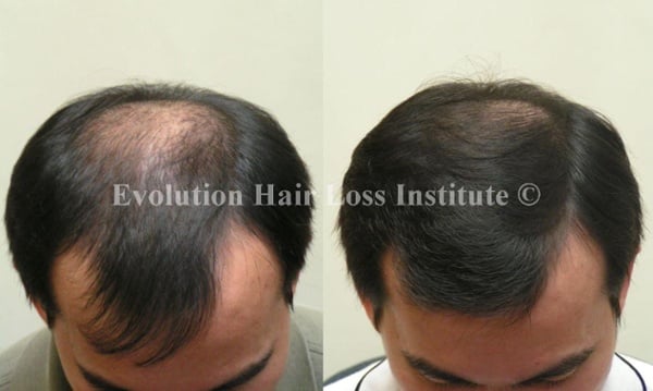 Before and After Photo Hair Loss Treatment Male Black Crown Regrowth
