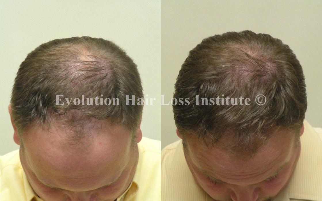 Before and After Hair Loss Treatment Male Crown and Frontal Frontal Large