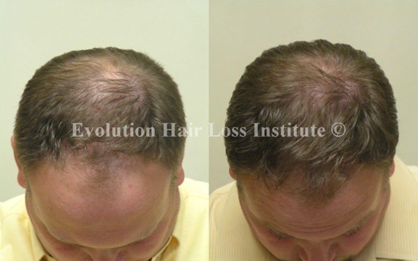 Before and After Photo Hair Loss Treatment Male Brown Frontal