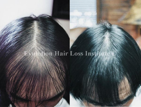 Before and After Photo Hair Regrowth Male Dark Hair Trasplant