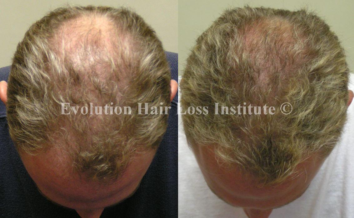 Before and After Hair Loss Treatment Male Blond Middle Vertex Large