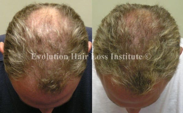 Before and After Photo Hair Loss Treatment Male Blond Middle Vertex
